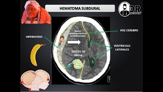 HEMATOMAS INTRACRANEALES EPIDURAL Y SUBDURAL  Como describir una Tomografía de cráneo [upl. by Anasus]