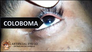 Coloboma Iris and Nystagmus  Anophthalmia  Dr Sumitra [upl. by Moretta]