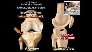 The Talar Tilt Test  Lateral Ankle Sprain [upl. by Vivle697]