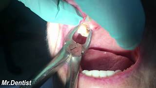 Extraction Of Molar Tooth [upl. by Aneehsirk]