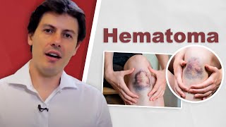 Hematoma Dr Fernando Amato [upl. by Adnirb187]