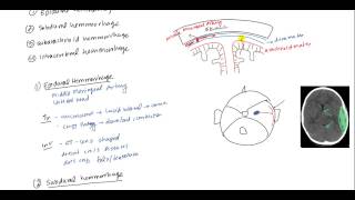 Epidural Hematoma Subdural hematoma Subarachnoid hematoma Intracerebral hemorrhage [upl. by Assen]