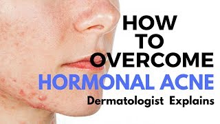 Skin Care Tips Treating HORMONAL ACNE [upl. by Ettegirb939]